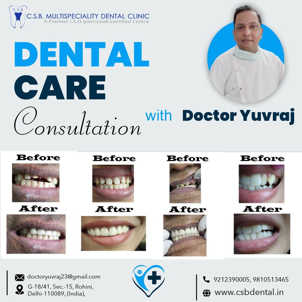 Denture Vs Implant in rohini sector 15, Delhi